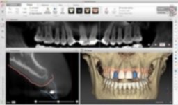 implantes-dentales-zaragoza-1-300x177.jpg